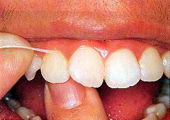 牙線刮牙面時,要繃緊牙齒的面,且略呈「C」形，使牙線的接觸面積能涵蓋整個鄰接面；當開始練習牙線時，由正中大門牙開始,然後循序向後牙移動，直到最後一顆牙的最後一面為止，換句話說由最容易得要領的前牙慢慢往後牙移動 
